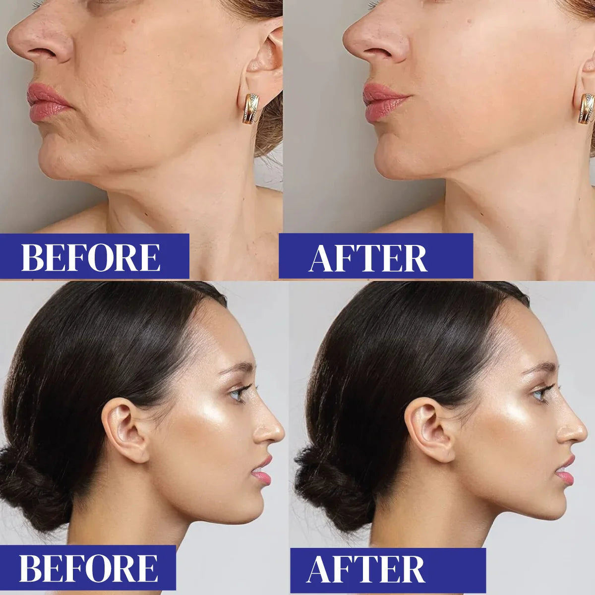 Facial Slimming Bandage for Double Chin Reduction