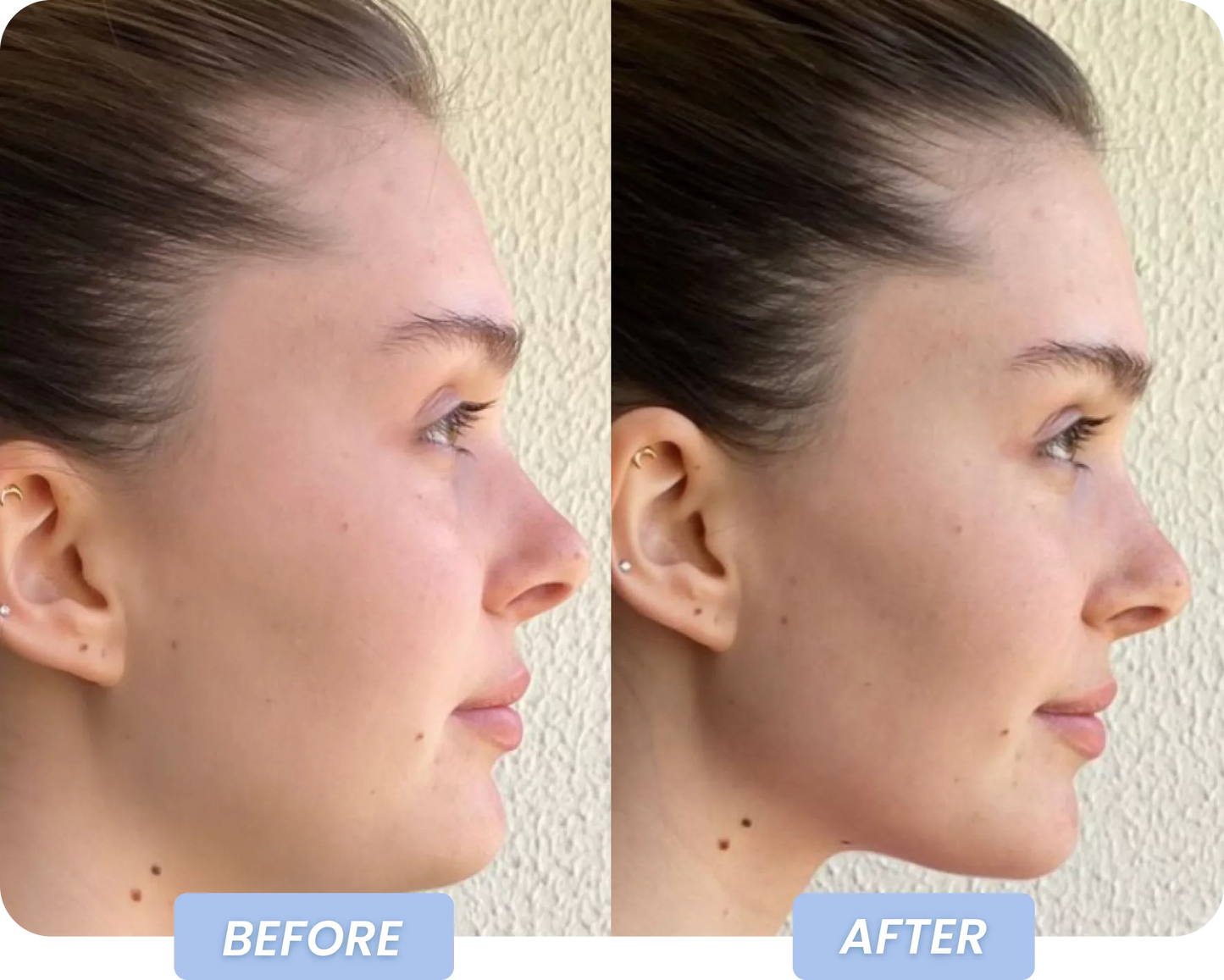 Facial Slimming Bandage for Double Chin Reduction